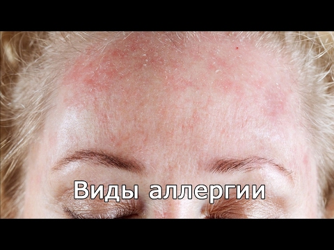 Виды аллергии