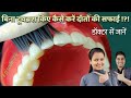बिना टूथब्रश किए कैसे करें दाँतों की सफाई |teeth cleaning without brushing danto ki safai Episode-24