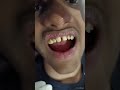 SMILE DESIGNING WITH ZIRCONIA CROWN. CONTACT:DR.J.SENTHILKUMAR 9940753151