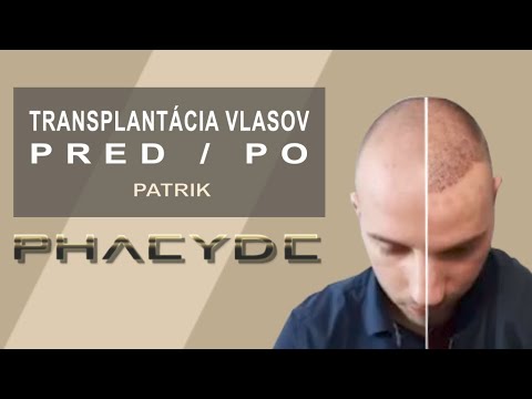 Video: Medovník sa chystá na transplantáciu vlasov