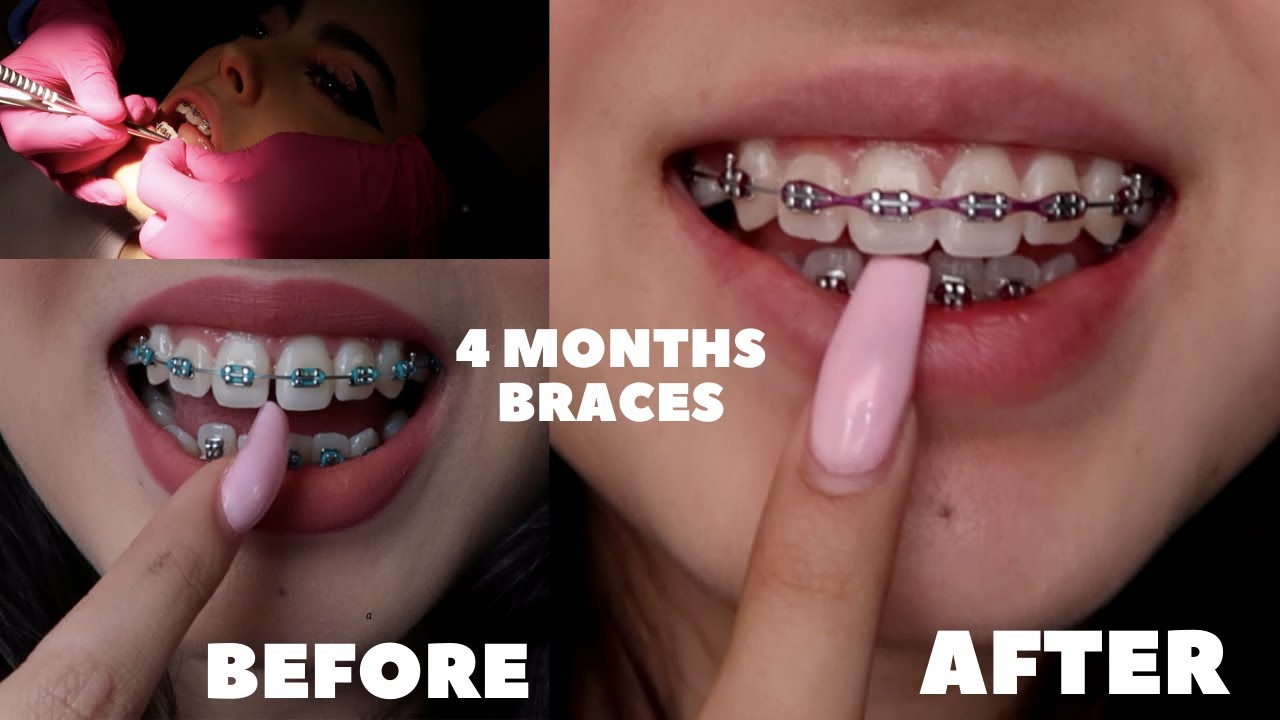 4 MONTHS BRACES UPDATE HUGE CHANGES YouTube