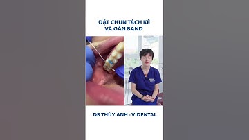 Quy trình đặt chun tách kẽ và gắn band, dân niềng nên biết | Nha Khoa ViDental #nhasi #niengrang