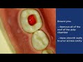 Pulpotomy of Deciduous Molar - QMUL