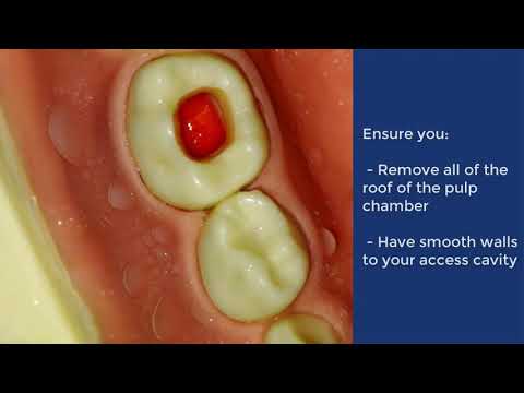 Video: Pulpotomi: Prosedur, Apa Yang Diharapkan, Dan Pemulihan