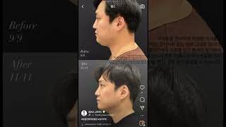 남성분들에게도 인기 많은 얼굴지방흡입 만족도 높은 시술 보장:)^^🩷#아쥬르의원 #실리프팅 #얼굴지방흡입