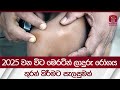 මෙරට ලාදුරු රෝගීන් ගෙන් 14%ක් දරුවන් | Leprosy in Sri Lanka | Rupavahini News