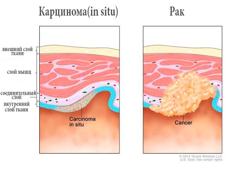 Что нужно знать о карциноме (in situ)? (подкаст)