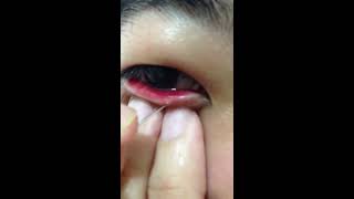Question: Can I pop a stye with a needle? (2021) Question: Can I pop a stye with a needle? (2021)