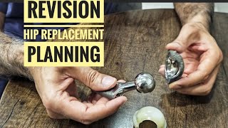 Revision Hip Replacement : How to plan ?