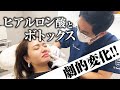 【施術動画】唇ヒアルロン酸＆口角・小鼻ボトックスを注入してみた【劇的変化】