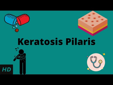 केराटोसिस पिलारिस, कारण, संकेत और लक्षण, निदान और उपचार।