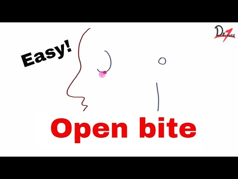 Management of anterior open bite