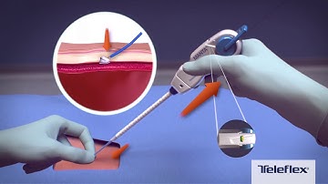 MANTA® Vascular Closure Device, Deployment Video