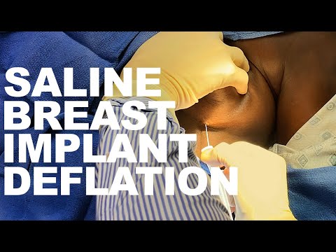 saline-breast-implant-deflation--dr.-paul-ruff-|-west-end-plastic-surgery