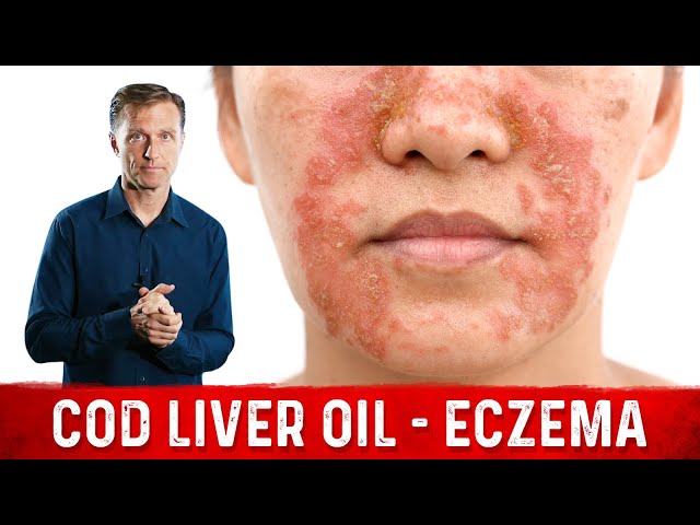 Why Use Cod Liver Oil for Eczema Remedies for Eczema Dr. Berg