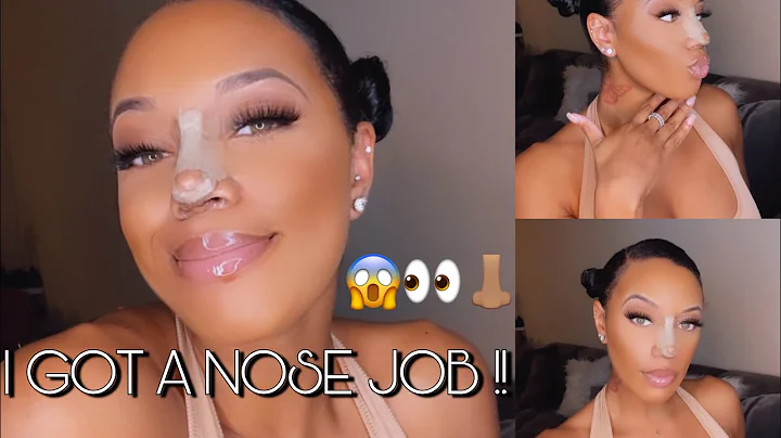 I GOT A NOSE JOB !! My Ethnic Rhinoplasty Journey ...