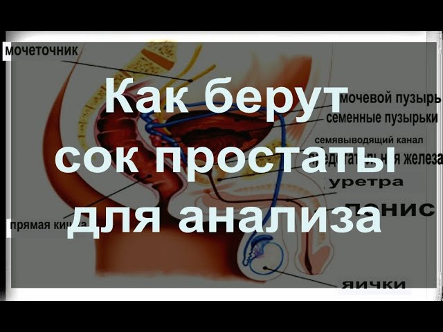 Как берут на анализ сок простаты?