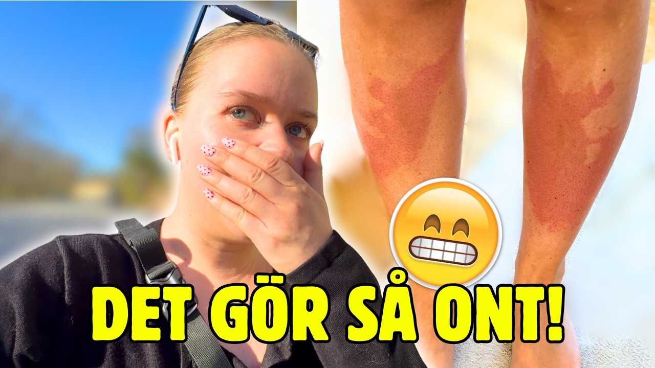 BLEV BRÄNNSKADAD 😭| Vlogg