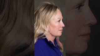 NO MORE Saggy Neck &amp; Jowls! Facelift Transformation to Get Rid of Jowls!