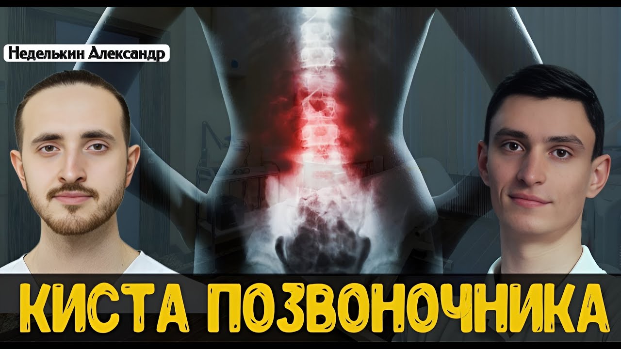 Что такое киста позвоночника?