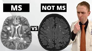 MS MRI Lesions VS. 'Benign' White Matter Lesions Explained by Neurologist