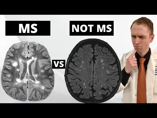 ms mri brain scan results