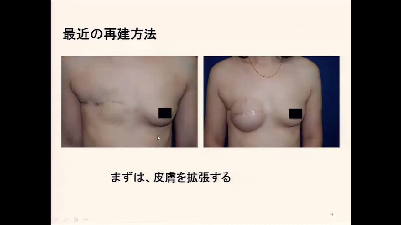 乳がん術後の変形 乳房下垂など 診療案内 香川大学医学部附属病院 形成外科 美容外科