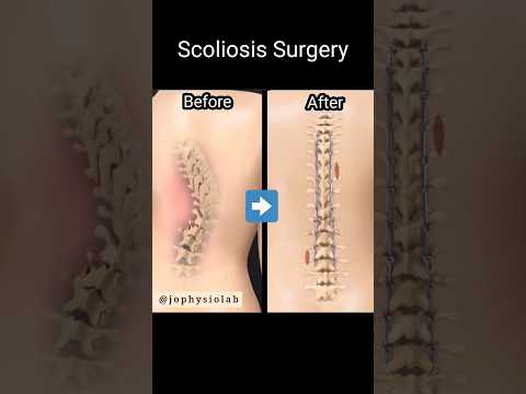 Video: Scoliose behandelen: 15 stappen (met afbeeldingen)