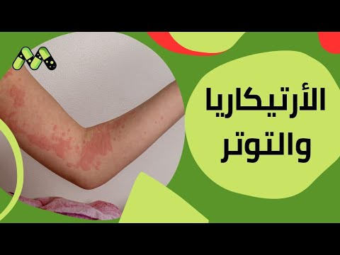 الأرتيكاريا والتوتر نصائح للسيطرة على الأعراض مع أ د أمجد الحداد