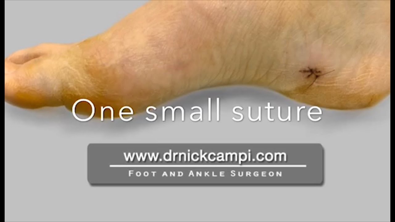 Laser Bunion Surgery: Is it Possible? | Northwest Surgery Center