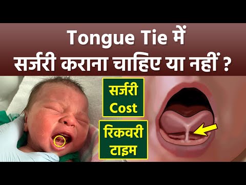 Newborn Tongue Tie Surgery कर न च ह ए य नह Procedure Cost Recovery Time Details Boldsky