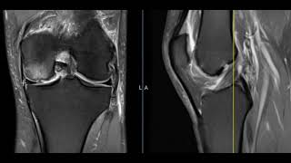 Video report from First Look MRI - knee pain