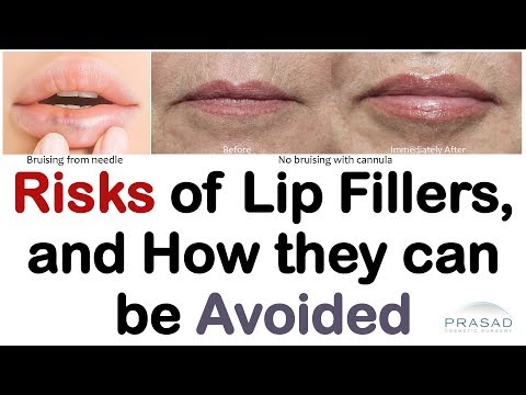 Video: Question To An Expert: How To Reduce Lips After Hyaluronic Acid Injection?