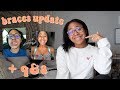 do i regret getting extractions.... well here's the tea | Braces Update + Q&A