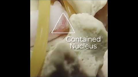 PainAtlanta.com - Annular Tear