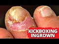 Removal Of Ingrown Nail On Champion Muay Thai Kickboxer!