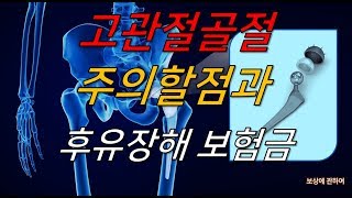 고관절골절 후유장해보험금 [보상에관하여]