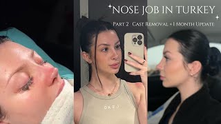 I Got a RHINOPLASTY in Turkey! Part 2 | Cast Removal + Nose Job 1 Month Update | Dr Sedat Ruzgar