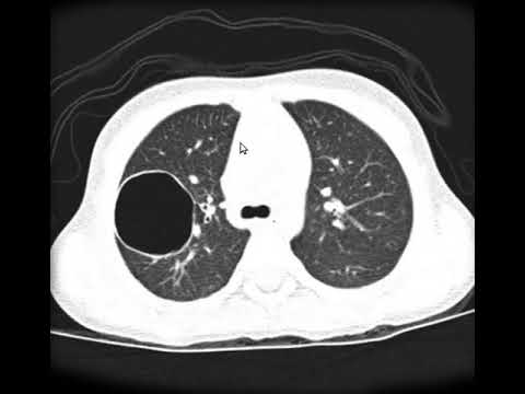 Video: Što je plućna pneumatocela?