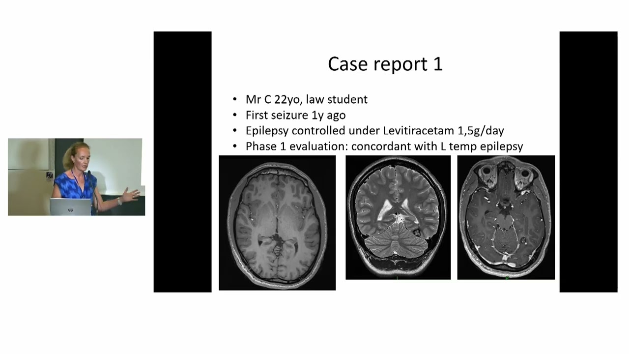 Cerebral cavernoma  LITT