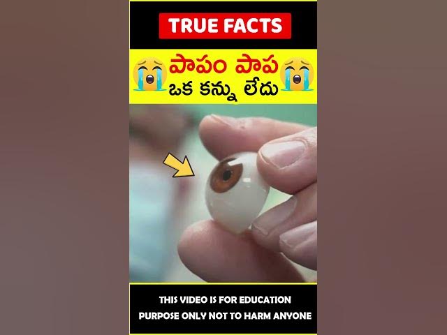 Doctor makes 3d eye for girl #factsintelugu 😭పాపం పాప😭 #amazingfacts #truefacts #shorts