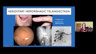 Four Things the World Should Know About Hereditary Hemorrhagic Telangiectasia (HHT)