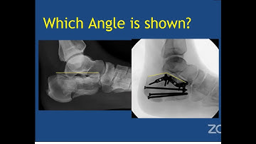 Intra articular Fractures of the Calcaneus
