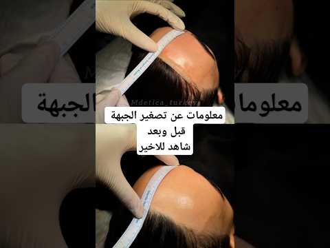 عملية تصغير الجبهة للمتعالجة قبل وبعد