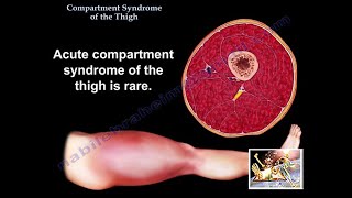 Compartment Syndrome Of The Thigh - Everything You Need To Know - Dr. Nabil Ebraheim