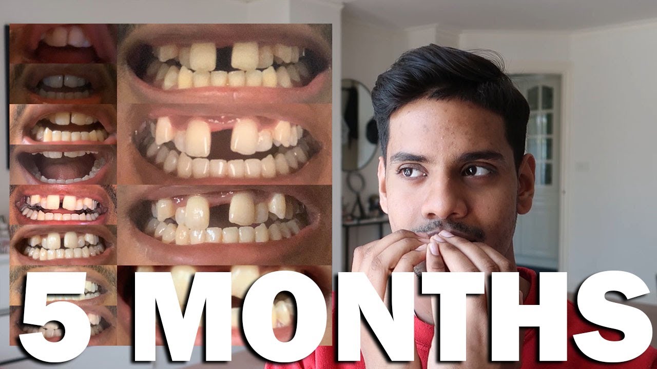 5Months PostOp Jaw Expansion Surgery (SARPE) Brace yourself! YouTube