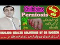 Chilblains (Perniosis) Treatment