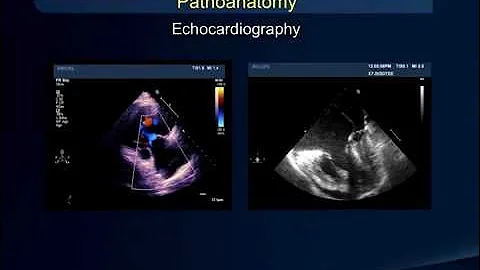 Jerome S Zacks MD Speaks to NorCal Carcinet