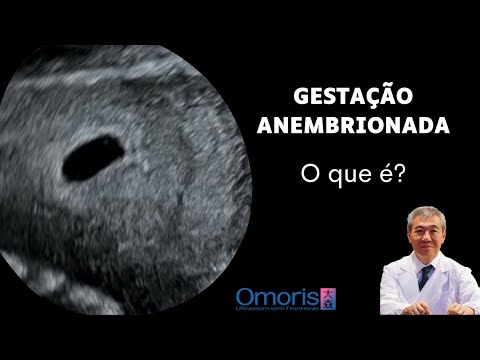 Video: Uterasi iliyozidi iligunduliwa lini?