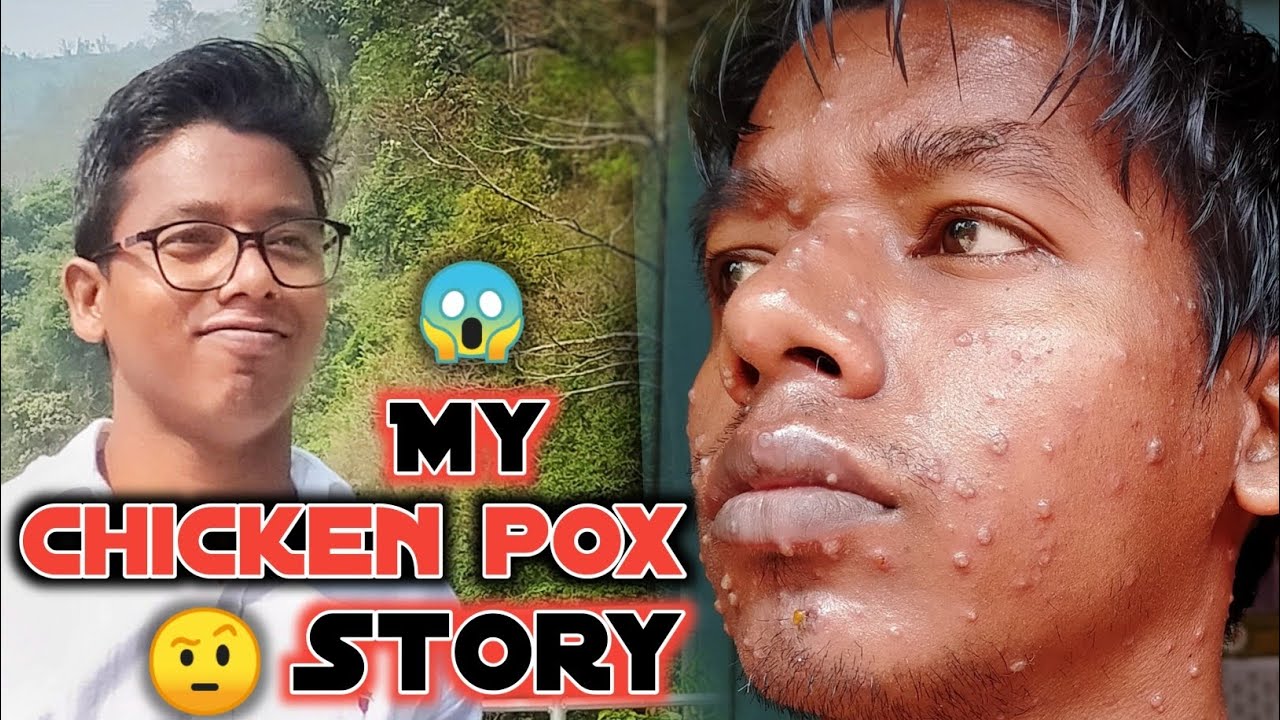 मुझे हुआ Chickenpox 😷 छोटी माता | कैसा लगता है जब होता है Chickenpox 😱 | RKDS 